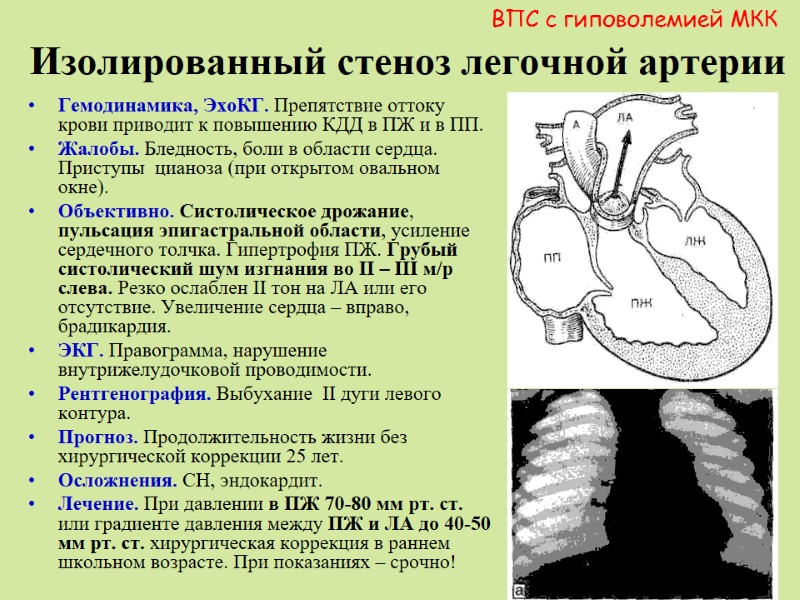 Изолированный стеноз легочной артерии  Гемодинамика, ЭхоКГ. Препятствие оттоку  крови приводит к повышению